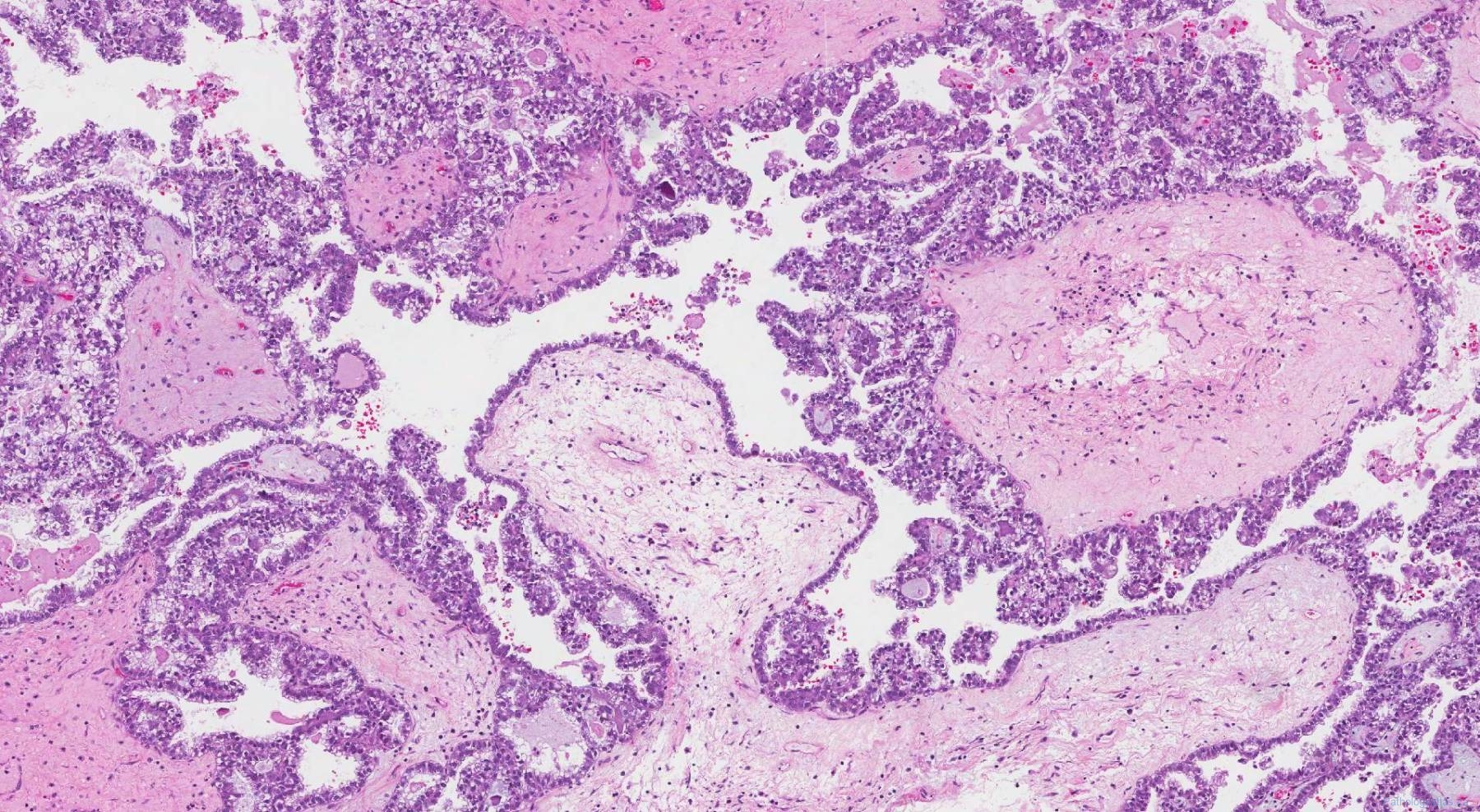 ovary-and-fallopian-tube-atlas-of-pathology