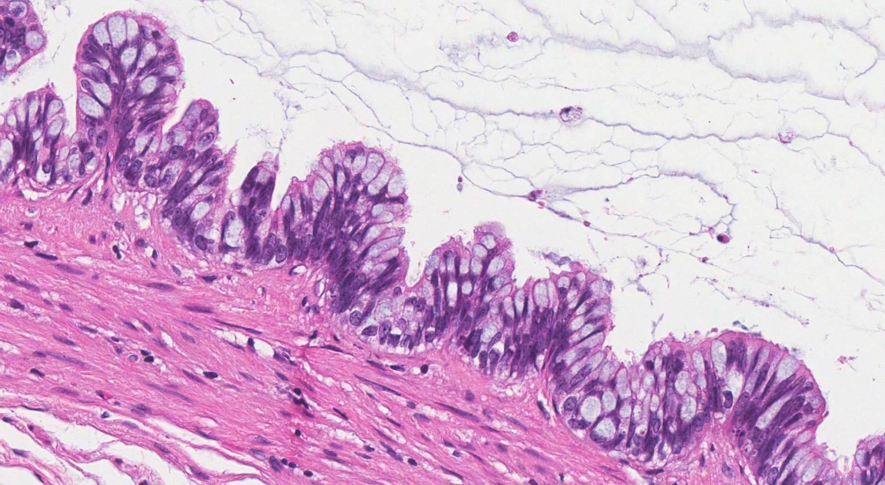 Low grade appendiceal mucinous neoplasm | Ottawa Atlas of Pathology