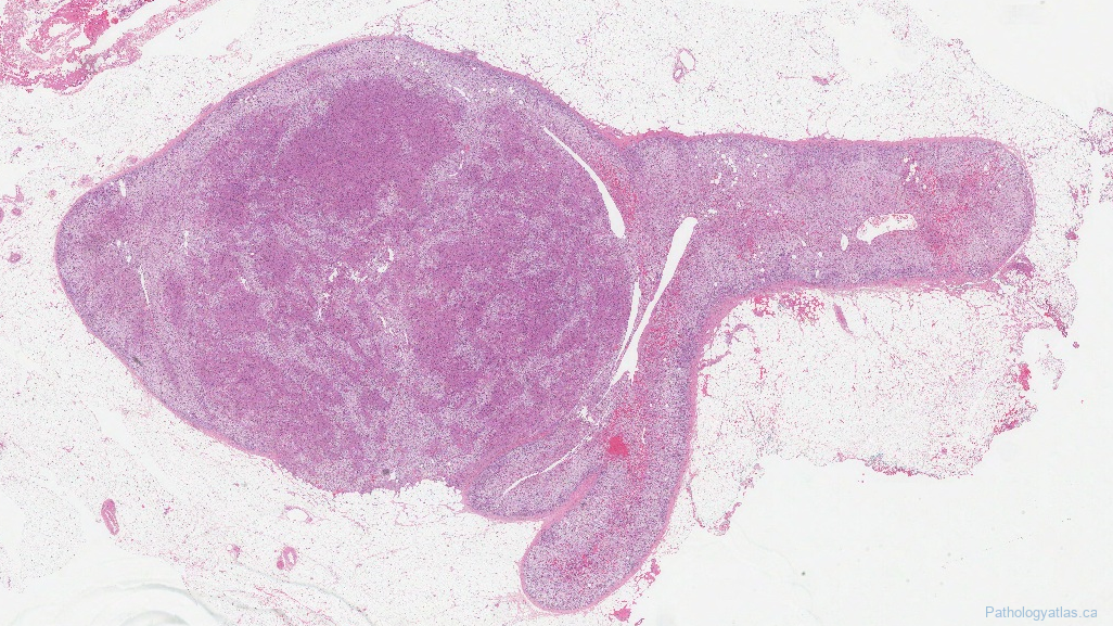 Adrenal Cortical Adenoma Ottawa Atlas Of Pathology 2689