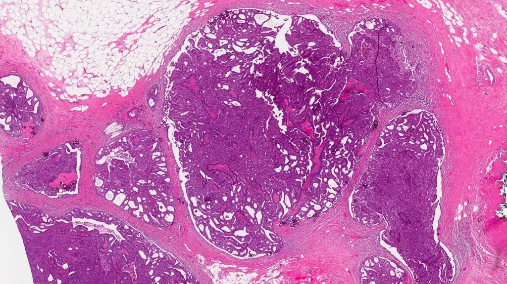 icd 10 code for left breast encapsulated papillary carcinoma