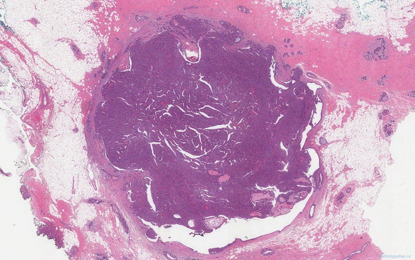 Intraductal papilloma of the breast | Ottawa Atlas of Pathology