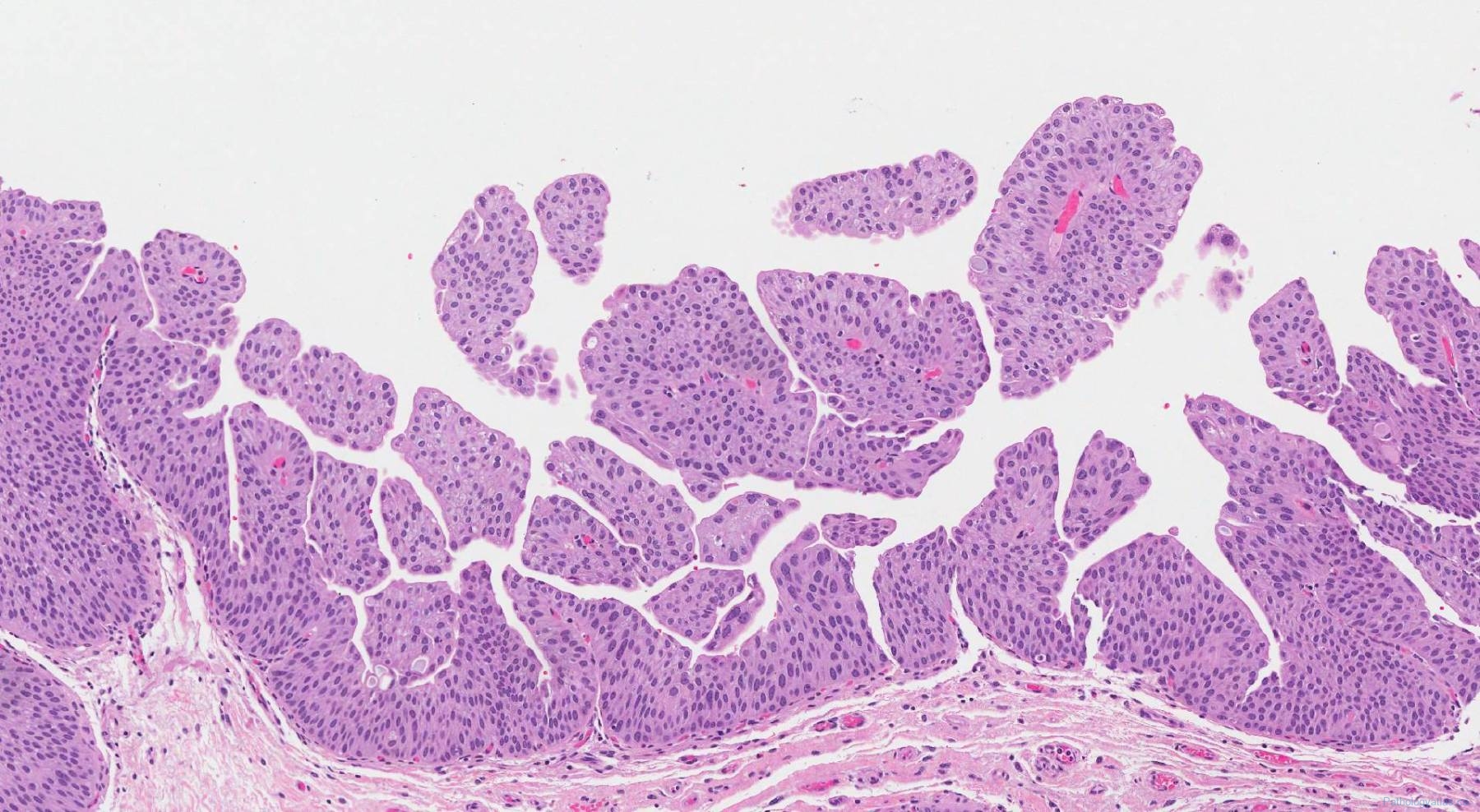 icd 10 non invasive high grade papillary urothelial carcinoma