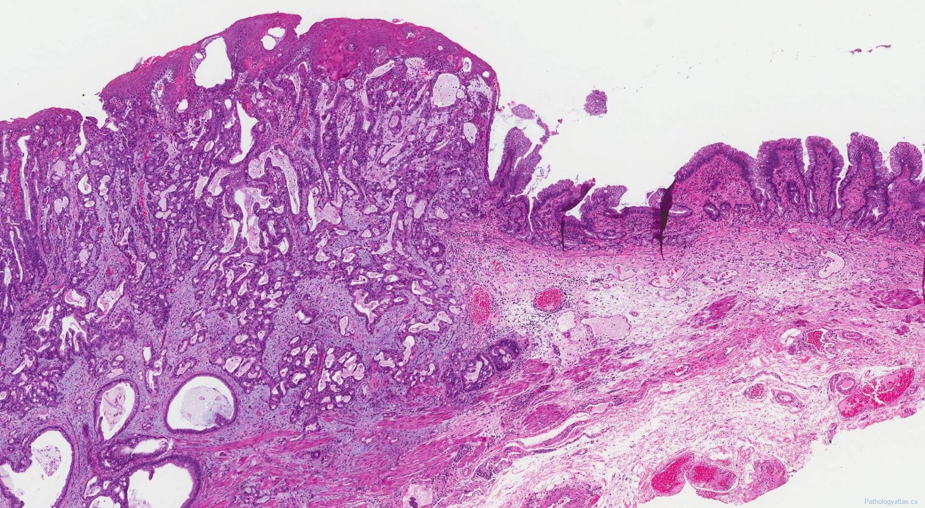 Adenocarcinoma Of The Esophagus | Ottawa Atlas Of Pathology