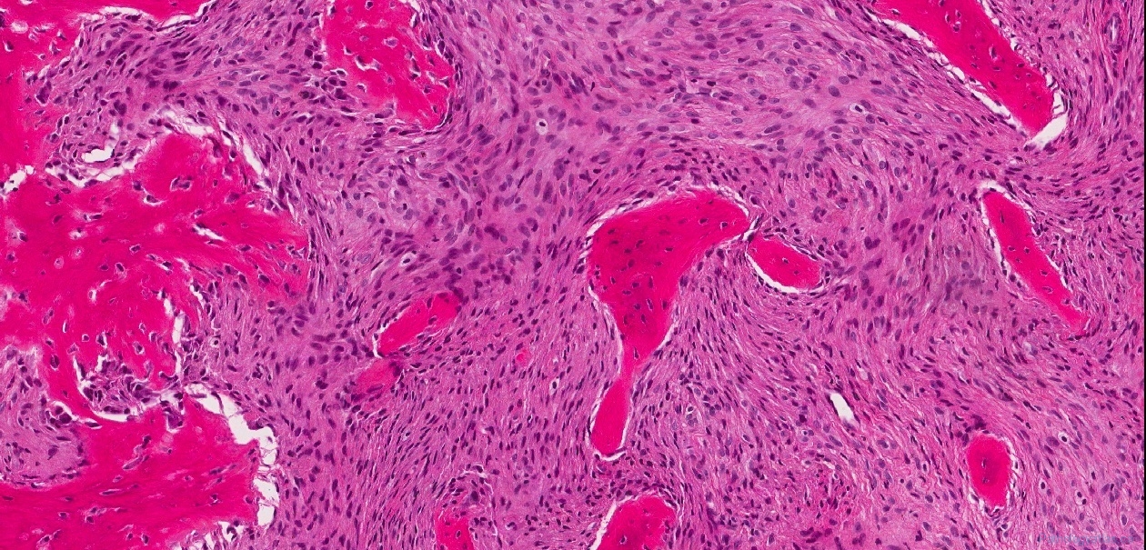 Low grade central osteosarcoma | Ottawa Atlas of Pathology