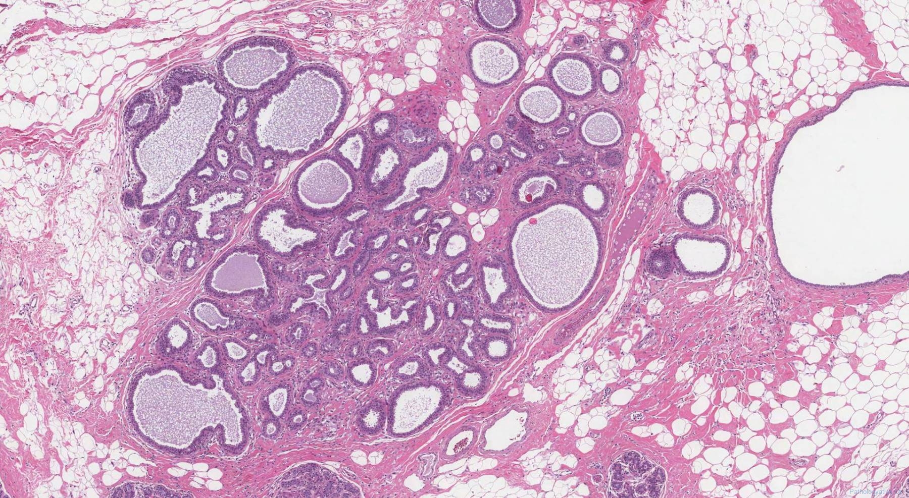 fibrocystic-disease-of-the-breast-ottawa-atlas-of-pathology