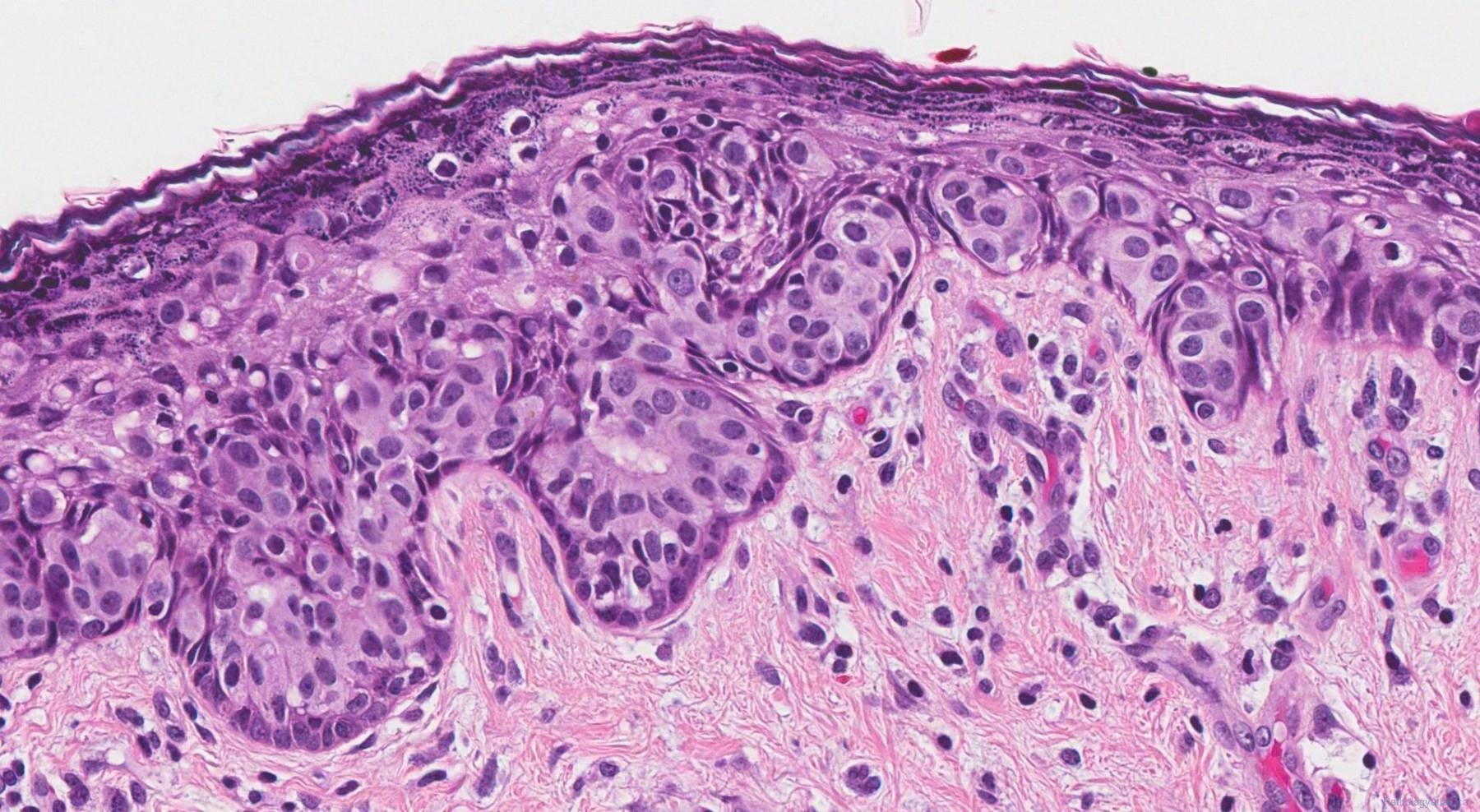 Paget carcinoma