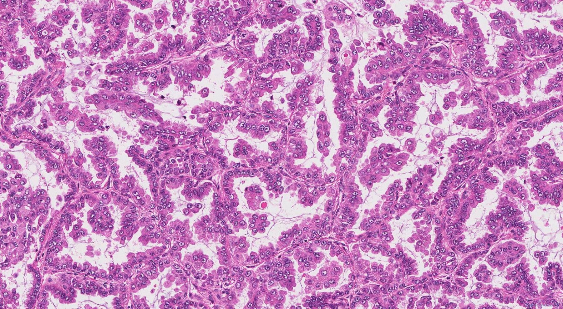 Adenocarcinoma Of The Lung | Ottawa Atlas Of Pathology