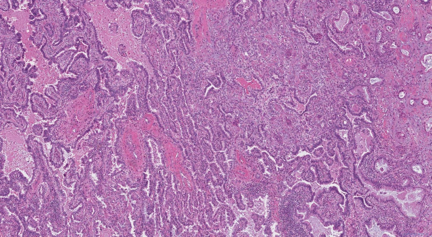 Adenosquamous Carcinoma Of The Lung Ottawa Atlas Of Pathology