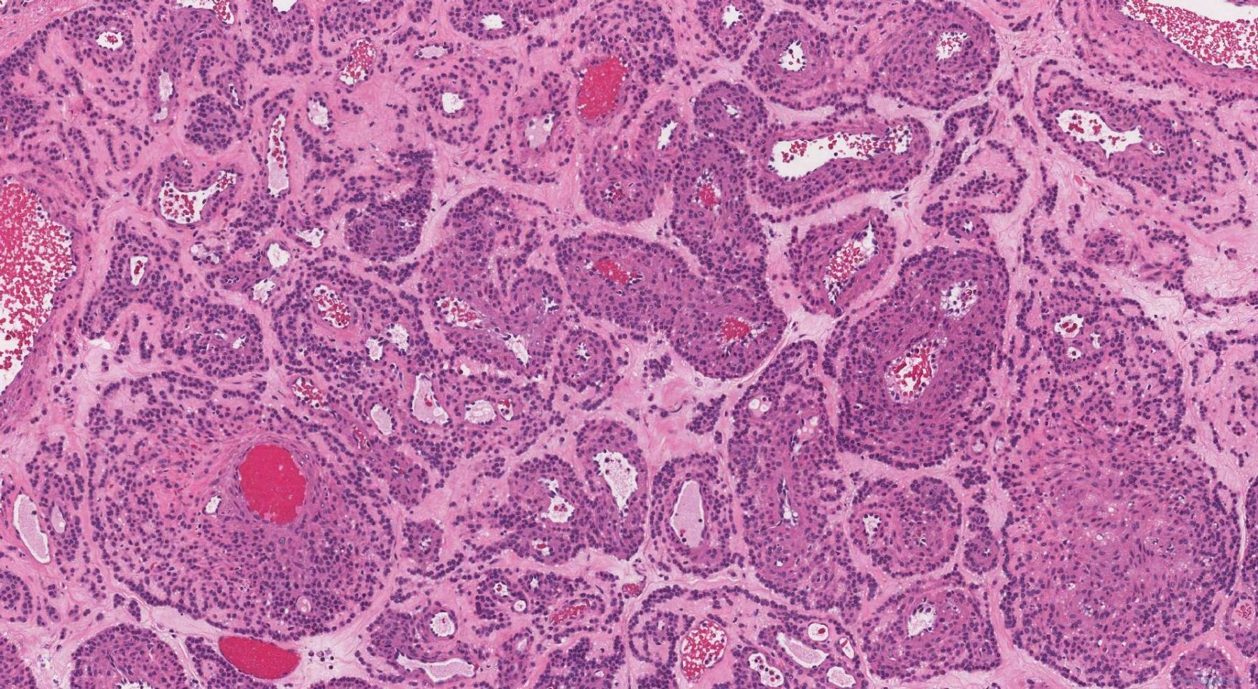 Glomus tumour | Ottawa Atlas of Pathology