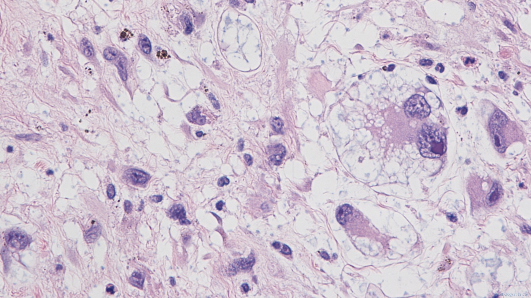 Myxoinflammatory fibroblastic sarcoma | Atlas of Pathology