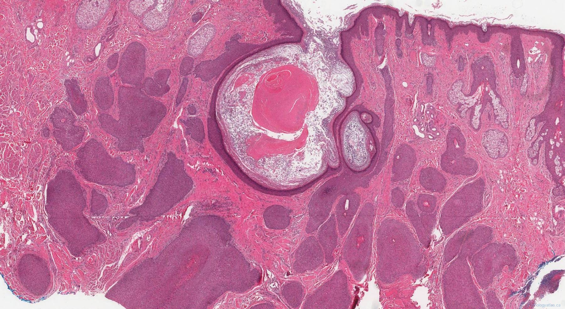 Pilar sheath acanthoma | Ottawa Atlas of Pathology