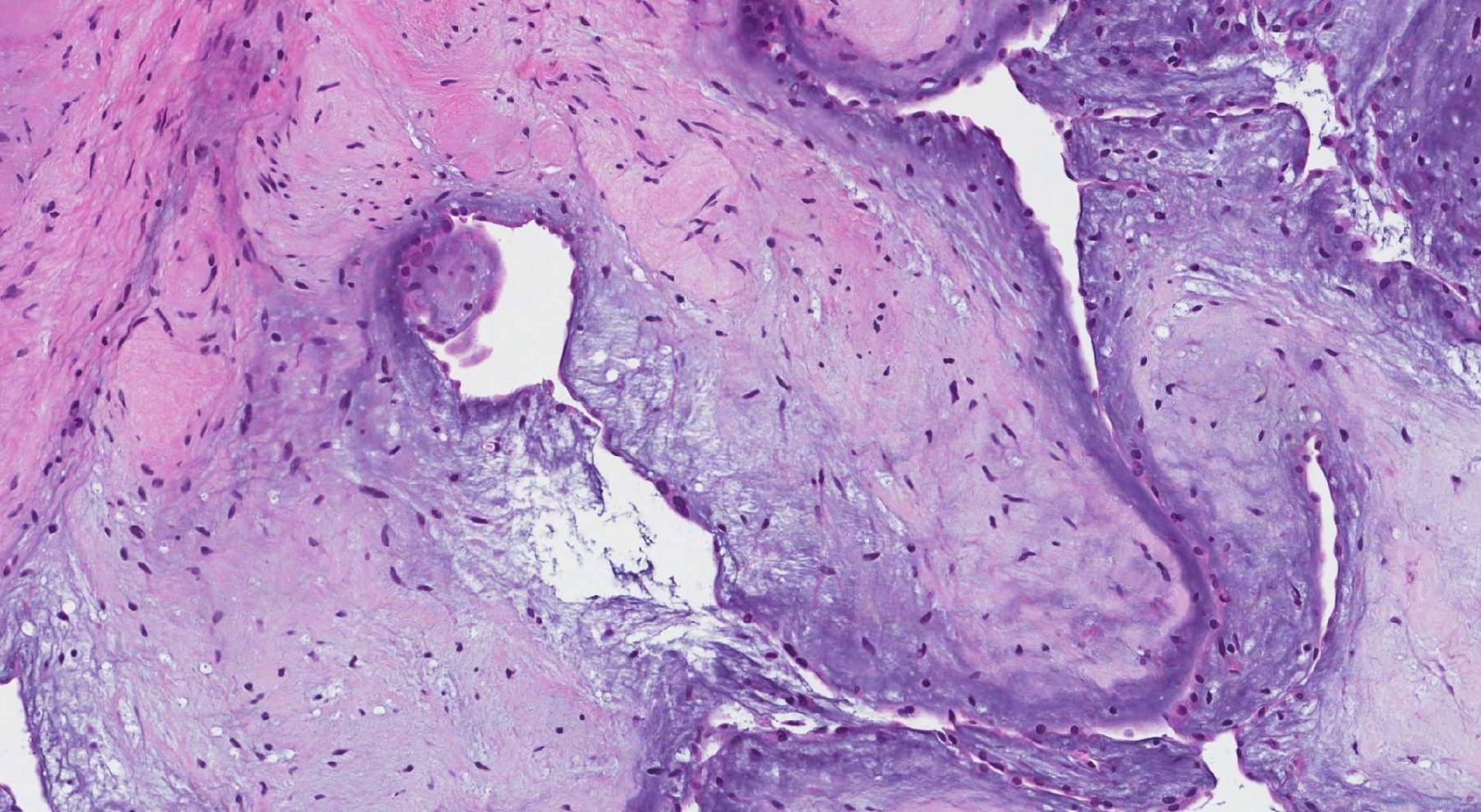 Papillary fibroelastoma | Ottawa Atlas of Pathology