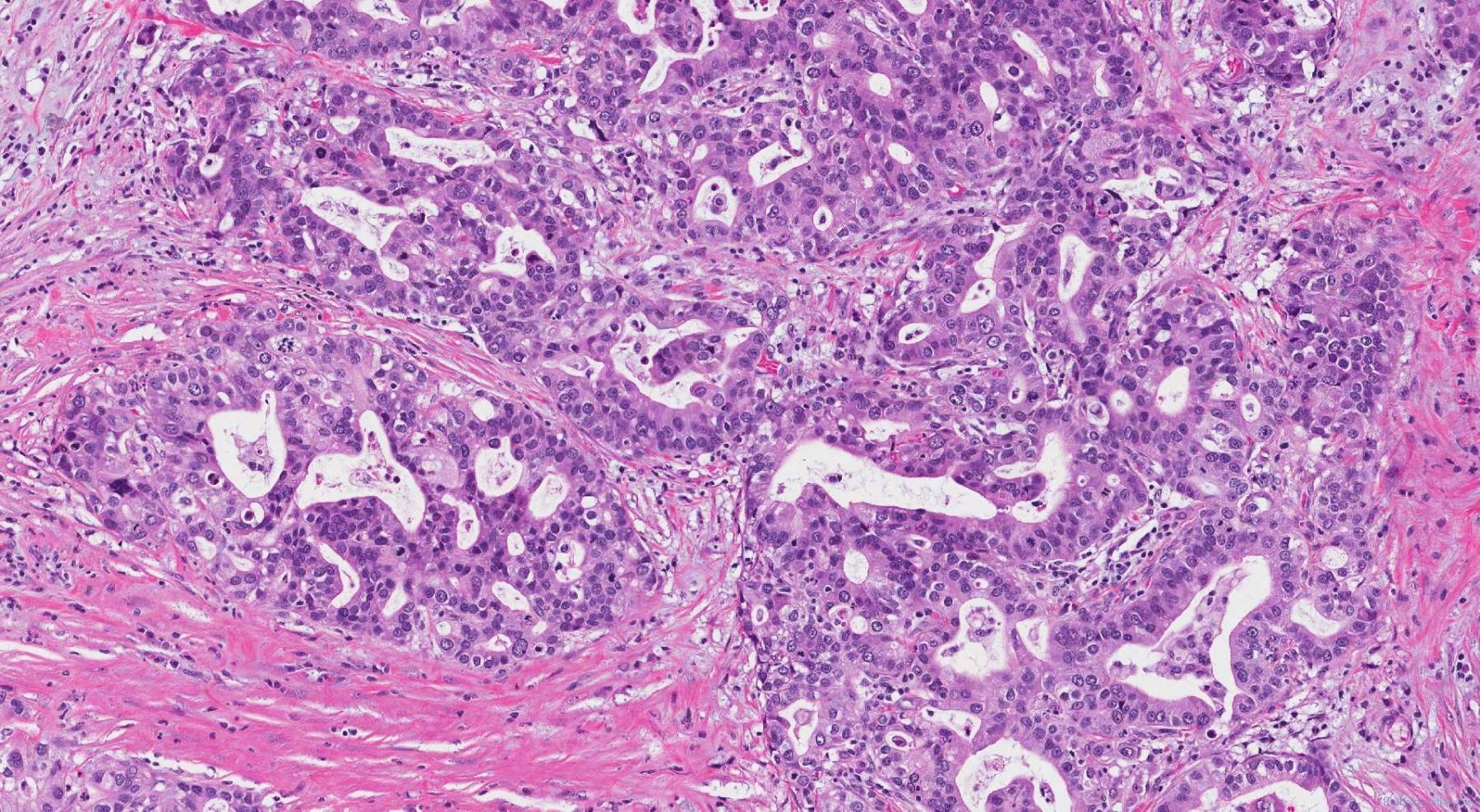 Ampullary adenocarcinoma | Ottawa Atlas of Pathology