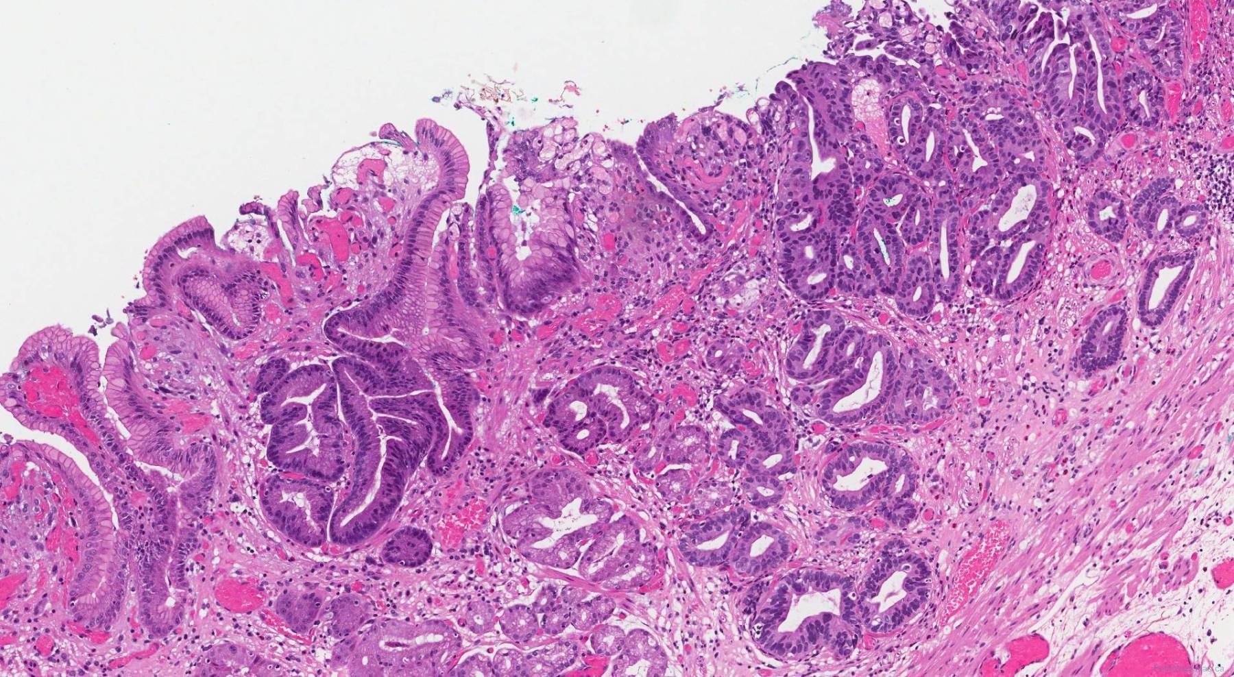 Intramucosal Adenocarcinoma Of The Stomach Ottawa Atlas Of Pathology