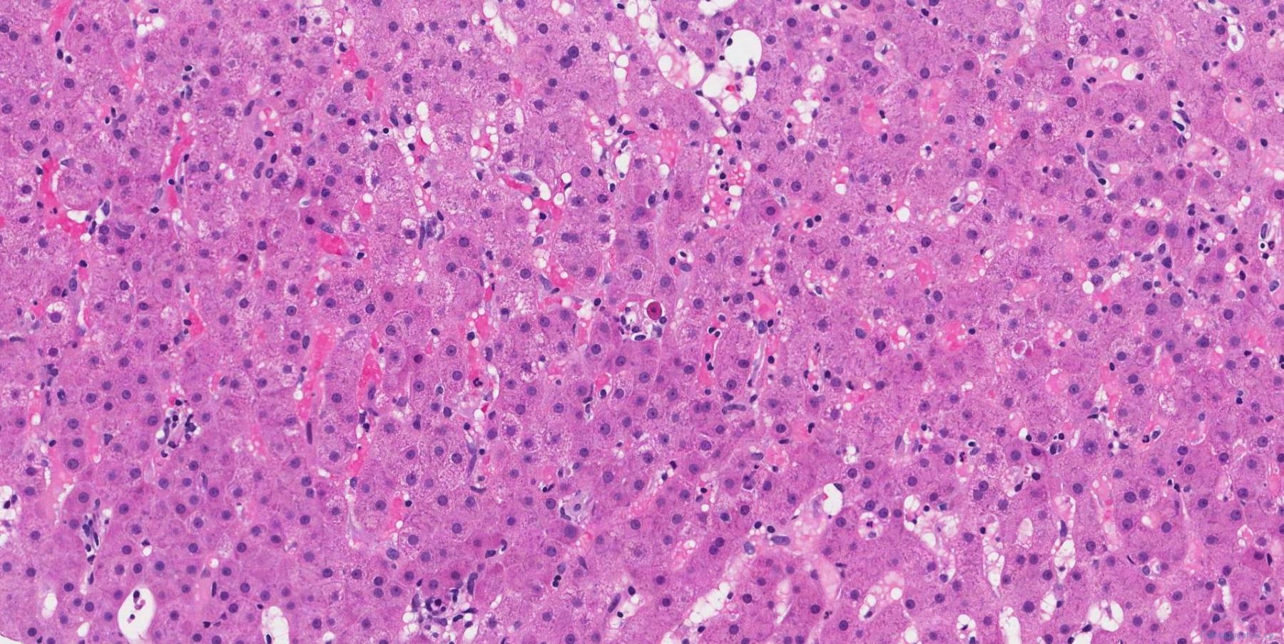 Lobular inflammation in the liver | Ottawa Atlas of Pathology